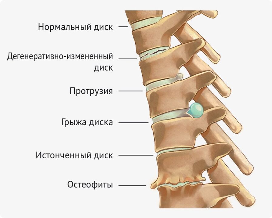 Disc deformities for lumbar osteochondrosis