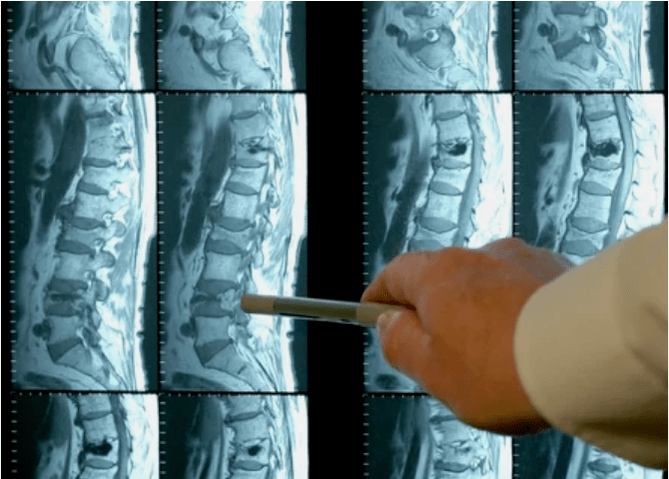 Osteochondrosis varieties in the spine
