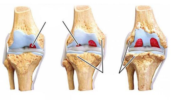 arthrosis
