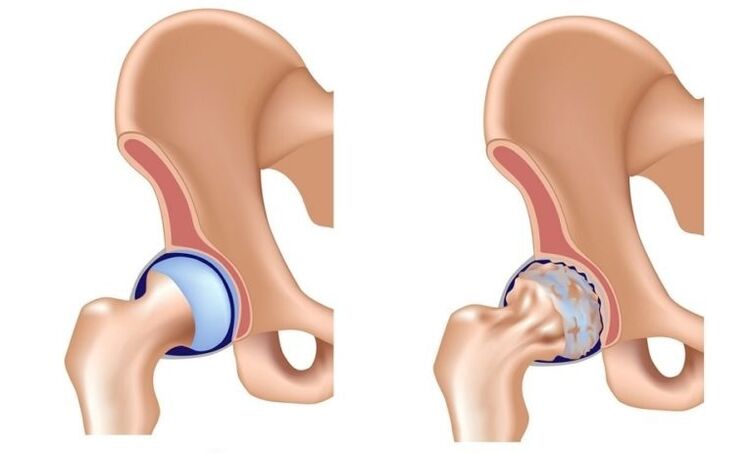 Healthy becomes and joint with arthrosis