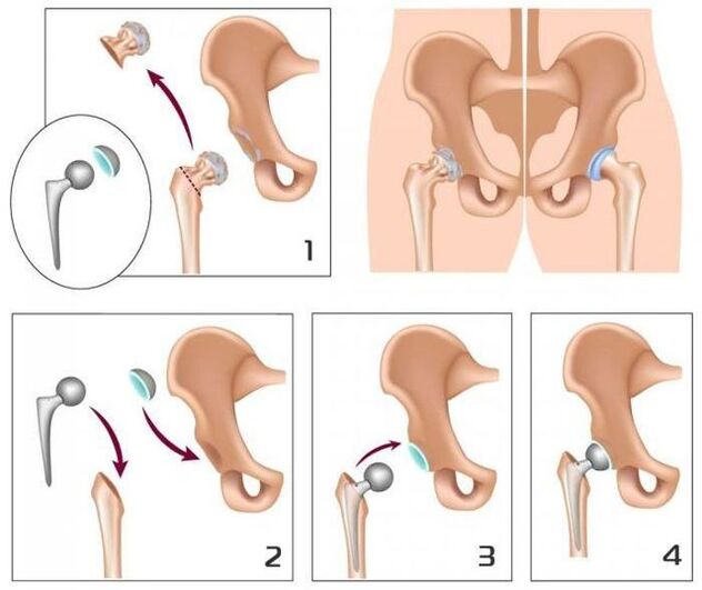Replacement of inflamed joint with prosthesis