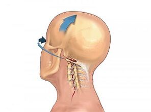How is the osteochondrosis of the cervical spine manifested