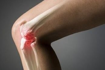 Knee joint arthrosis is a lesion of cartilage tissue
