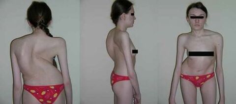 spine curvature as a consequence of osteochondrosis