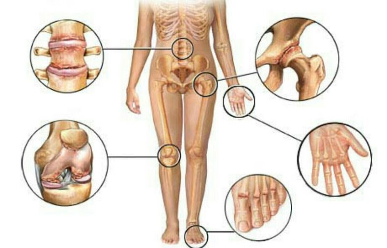Types and degrees of arthrosis