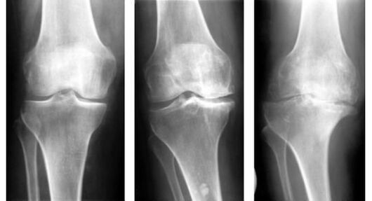 A mandatory diagnostic measure when identifying knee arthrosis is an X-ray examination