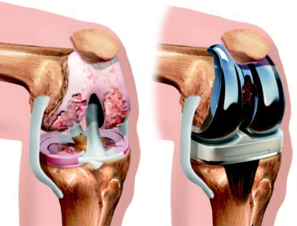 In case of complete damage to the knee joint from arthrosis, it can be restored by endoprosthetics